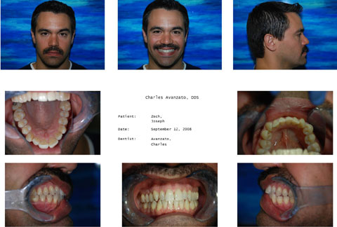 Invisalign Case 1