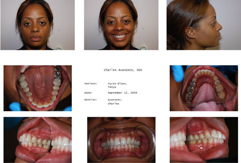 Invisalign Case 2