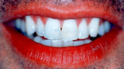 Veneers